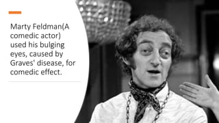 Marty Feldman(A
comedic actor)
used his bulging
eyes, caused by
Graves' disease, for
comedic effect.
 