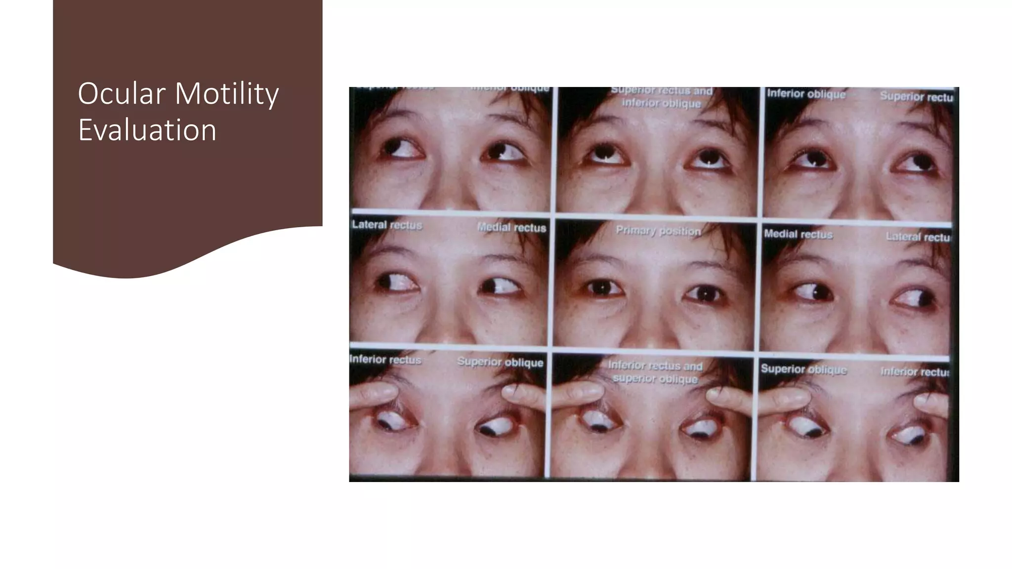 Binocular Vision and Ocular Motility | PPTX