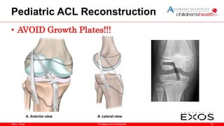 Plano, Texas
Pediatric ACL Reconstruction
• AVOID Growth Plates!!!
19
Privileged and Confidential
 