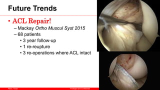 Plano, Texas
Future Trends
• ACL Repair!
– Mackay Ortho Muscul Syst 2015
– 68 patients
• 3 year follow-up
• 1 re-reupture
• 3 re-operations where ACL intact
27
Privileged and Confidential
 