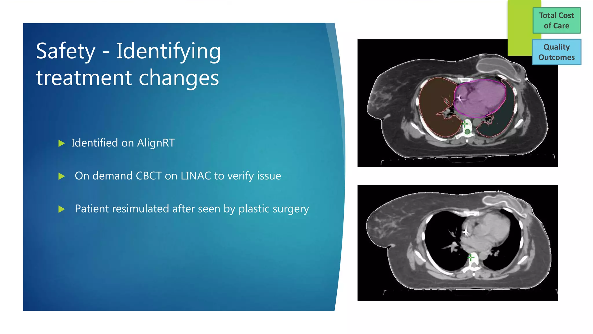 Safety - Identifying
treatment changes
 Identified on AlignRT
 On demand CBCT on LINAC to verify issue
 Patient resimulated after seen by plastic surgery
Total Cost
of Care
Quality
Outcomes
 