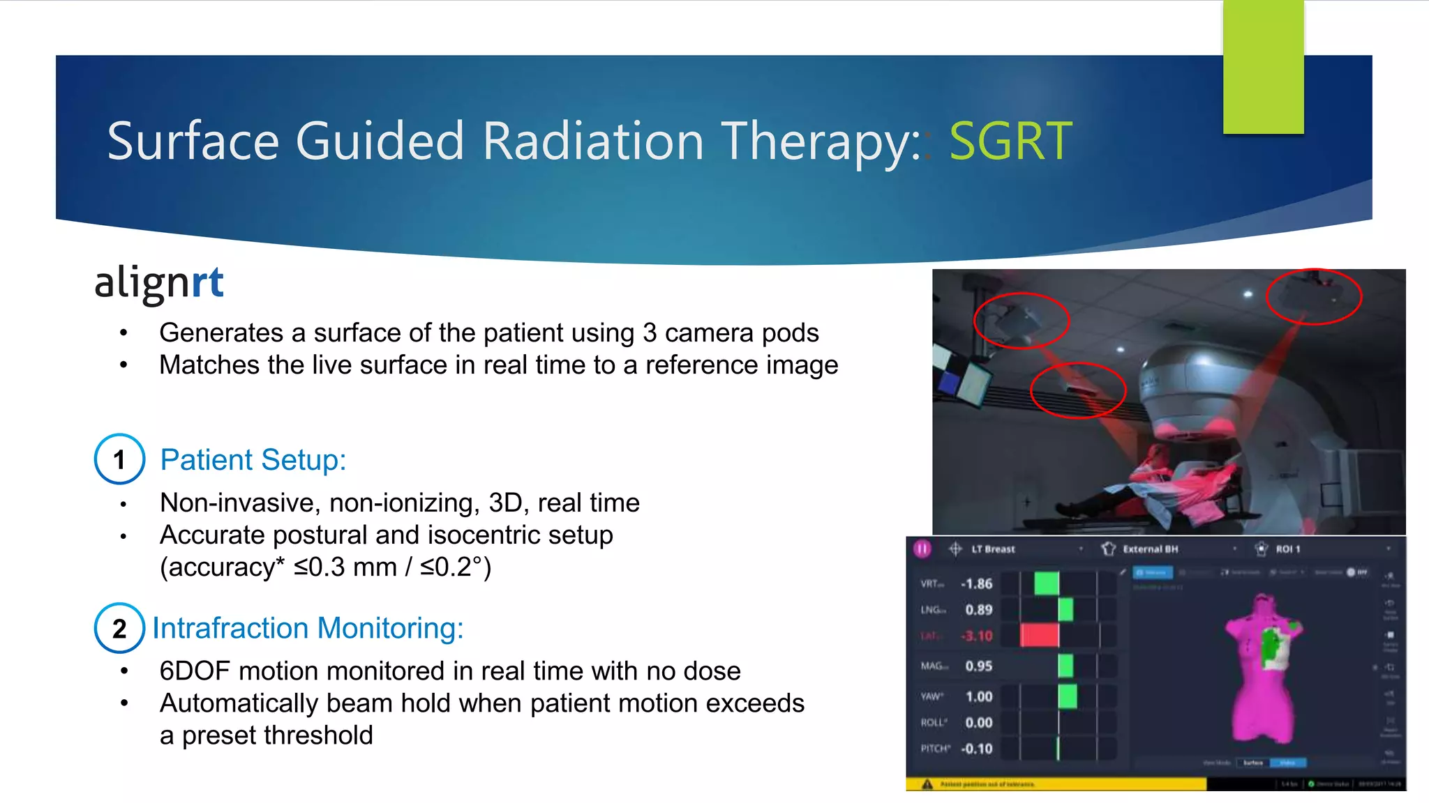 Surface Guided Radiation Therapy:: SGRT
Patient Setup:
• Non-invasive, non-ionizing, 3D, real time
• Accurate postural and isocentric setup
(accuracy* ≤0.3 mm / ≤0.2°)
Intrafraction Monitoring:
• 6DOF motion monitored in real time with no dose
• Automatically beam hold when patient motion exceeds
a preset threshold
1
2
• Generates a surface of the patient using 3 camera pods
• Matches the live surface in real time to a reference image
 