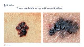 Melanoma: Prevention, Detection and Treatment - Stephanie Badalamenti ...