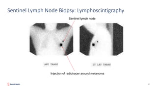 Sentinel Node Injection Wheel Melanoma: Prevention, Detection and Treatment - Stephanie Badalamenti ...