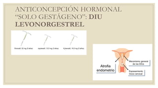 ANTICONCEPCIÓN HORMONAL
“SOLO GESTÁGENO”: DIU
LEVONORGESTREL
 