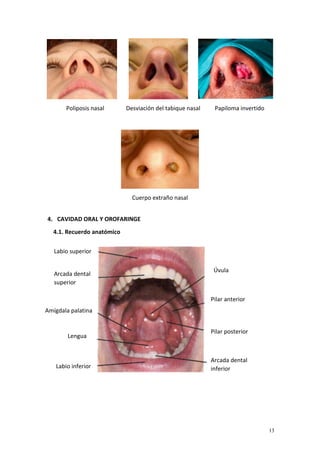 13
Poliposis nasal Desviación del tabique nasal Papiloma invertido
Cuerpo extraño nasal
4. CAVIDAD ORAL Y OROFARINGE
4.1. ...
