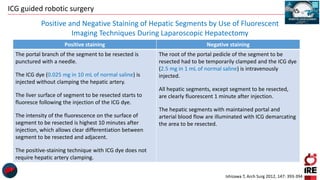 ICG guided robotic surgery
Ishizawa T, Arch Surg 2012, 147: 393-394
Positive staining Negative staining
The portal branch of the segment to be resected is
punctured with a needle.
The ICG dye (0.025 mg in 10 mL of normal saline) is
injected without clamping the hepatic artery.
The liver surface of segment to be resected starts to
fluoresce following the injection of the ICG dye.
The intensity of the fluorescence on the surface of
segment to be resected is highest 10 minutes after
injection, which allows clear differentiation between
segment to be resected and adjacent.
The positive-staining technique with ICG dye does not
require hepatic artery clamping.
The root of the portal pedicle of the segment to be
resected had to be temporarily clamped and the ICG dye
(2.5 mg in 1 mL of normal saline) is intravenously
injected.
All hepatic segments, except segment to be resected,
are clearly fluorescent 1 minute after injection.
The hepatic segments with maintained portal and
arterial blood flow are illuminated with ICG demarcating
the area to be resected.
Positive and Negative Staining of Hepatic Segments by Use of Fluorescent
Imaging Techniques During Laparoscopic Hepatectomy
 