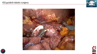 ICG guided robotic surgery
 