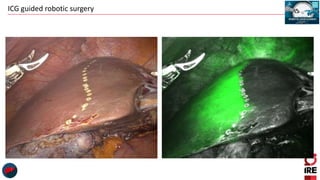ICG guided robotic surgery
 