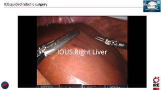 ICG guided robotic surgery
 