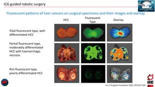 ICG guided robotic surgery
Liu T, Surgical Innovation 2022, 29:532–539
Fluorescent patterns of liver cancers on surgical specimens and their images and overlay
HCC
Fluorescent
Type
Overlay
Total fluorescent type, well-
differentiated HCC
Partial fluorescent type,
moderately differentiated
HCC with haemorrhagic
necrosis
Rim fluorescent type,
poorly differentiated HCC
 