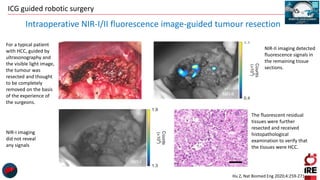 ICG guided robotic surgery
Hu Z, Nat Biomed Eng 2020;4:259-271
Intraoperative NIR-I/II fluorescence image-guided tumour resection
For a typical patient
with HCC, guided by
ultrasonography and
the visible light image,
the tumour was
resected and thought
to be completely
removed on the basis
of the experience of
the surgeons.
NIR-II imaging detected
fluorescence signals in
the remaining tissue
sections.
NIR-I imaging
did not reveal
any signals
The fluorescent residual
tissues were further
resected and received
histopathological
examination to verify that
the tissues were HCC.
 