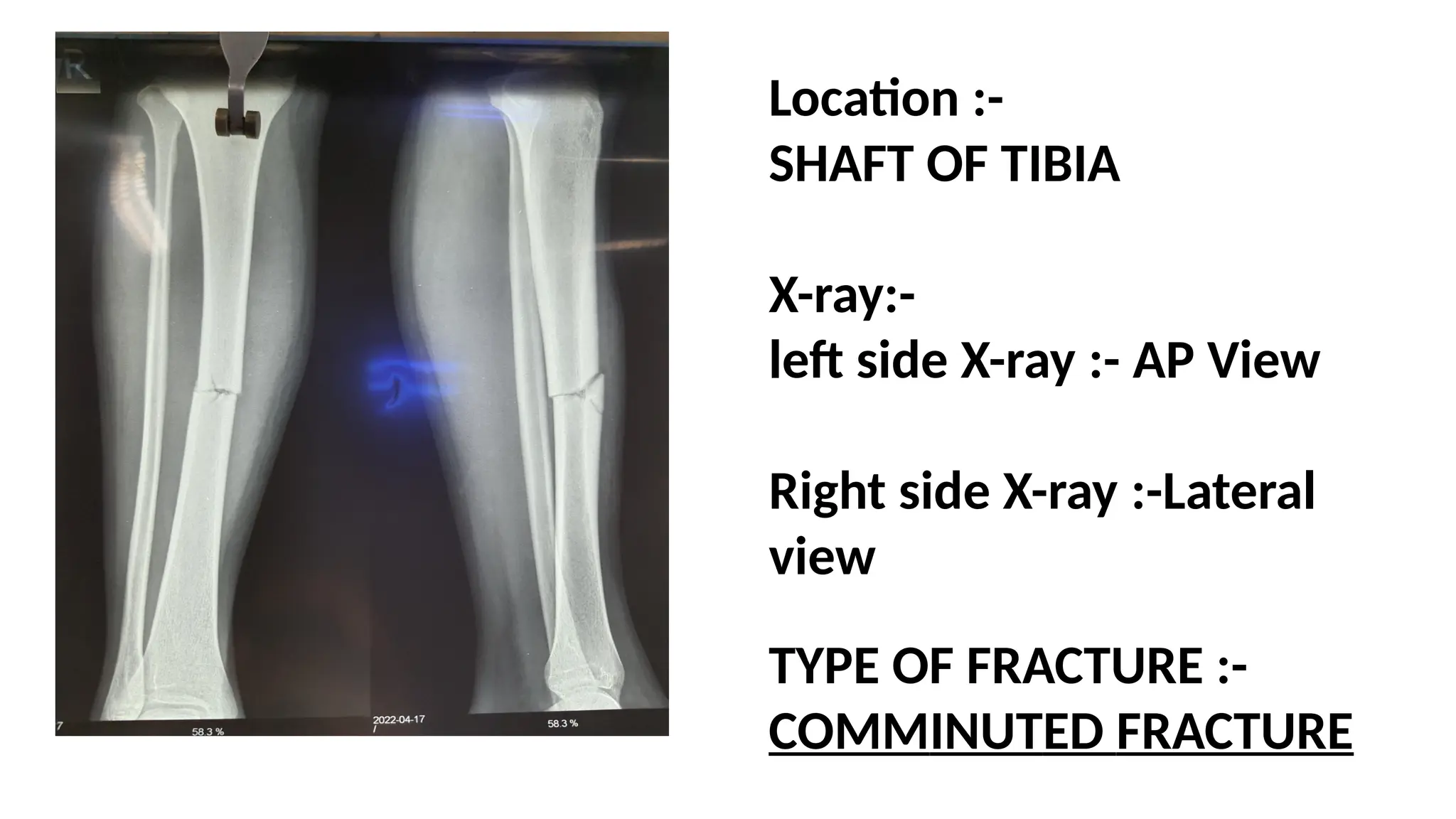 Location :-
SHAFT OF TIBIA
X-ray:-
left side X-ray :- AP View
Right side X-ray :-Lateral
view
TYPE OF FRACTURE :-
COMMINUTED FRACTURE
 