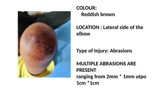 COLOUR:
Reddish brown
LOCATION : Lateral side of the
elbow
Type of Injury: Abrasions
MULTIPLE ABRASIONS ARE
PRESENT
ranging from 2mm * 1mm utpo
1cm *1cm
 