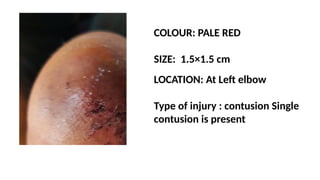 COLOUR: PALE RED
SIZE: 1.5×1.5 cm
LOCATION: At Left elbow
Type of injury : contusion Single
contusion is present
 