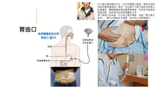 胃造口
五十歲出頭的賴先生在，五年前罹患口腔癌，歷經手術與
放射治療幸運撿回一條命，但也留下口腔不能咬合與張口
的後遺症，醫師建議長期放鼻胃管灌食，然而他不能接受
面貌改變，始終無法從疾病陰霾走出來。
做了胃造口手術後，可以自己動手灌食，他說「既方便又
乾淨」，還可以藏身在衣服裡，免去別人的異樣眼光。
 