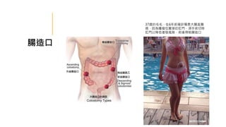 腸造口
37歲的毛毛，在6年前確診罹患大腸直腸
癌，因為腫瘤位置接近肛門，須手術切除
肛門以降低復發風險，術後得裝腸造口
 