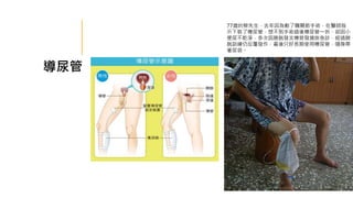 導尿管
77歲的蔡先生，去年因為動了髖關節手術，在醫師指
示下裝了導尿管，想不到手術過後導尿管一拆，卻因小
便尿不乾淨，多次因膀胱發炎導致發燒掛急診，經過膀
胱訓練仍反覆發作，最後只好長期使用導尿管，隨身帶
著尿袋。
 