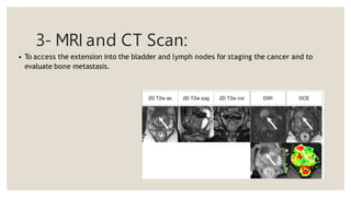 3- MRI and CT Scan:
• To access the extension into the bladder and lymph nodes for staging the cancer and to
evaluate bone metastasis.
 