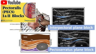 Interpectoral Block 2022 KSCTVA Sono-guided nerve blocks for cardio-thoracic surgery.pptx
