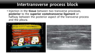 2022 KSCTVA Sono-guided nerve blocks for cardio-thoracic surgery.pptx
