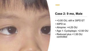 Case 2: 9 mo, Male
• +3.00 OU, still w 30PD ET
• 40PD sc
• Atropine: +4.25 OU
• Age 1: Cycloplegic: +2.50 OU
• Reduced plus +1.50 OU
controlled
 