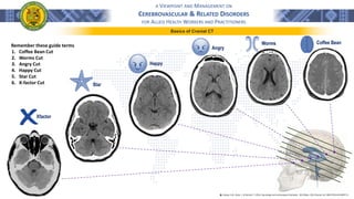 A VIEWPOINT AND MANAGEMENT ON
CEREBROVASCULAR & RELATED DISORDERS
FOR ALLIED HEALTH WORKERS AND PRACTITIONERS
Basics of Cranial CT
Remember these guide terms
1. Coffee Bean Cut
2. Worms Cut
3. Angry Cut
4. Happy Cut
5. Star Cut
6. X-factor Cut
Coffee Bean
Worms
Angry
Happy
Xfactor
Star
֍ Lindsay, K.W., Bone, I., & Geraint, F. (2011). Neurology and neurosurgery illustrated - 5th Edition. 2011 Elsevier Ltd. ISBN 978-0-443-06957-4
 