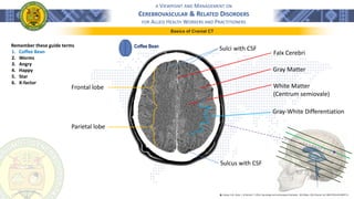 A VIEWPOINT AND MANAGEMENT ON
CEREBROVASCULAR & RELATED DISORDERS
FOR ALLIED HEALTH WORKERS AND PRACTITIONERS
Basics of Cranial CT
Coffee Bean
Frontal lobe
Parietal lobe
Falx Cerebri
Gray Matter
White Matter
(Centrum semiovale)
Gray-White Differentiation
Remember these guide terms
1. Coffee Bean
2. Worms
3. Angry
4. Happy
5. Star
6. X-factor
Sulcus with CSF
Sulci with CSF
֍ Lindsay, K.W., Bone, I., & Geraint, F. (2011). Neurology and neurosurgery illustrated - 5th Edition. 2011 Elsevier Ltd. ISBN 978-0-443-06957-4
 