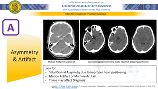 A VIEWPOINT AND MANAGEMENT ON
CEREBROVASCULAR & RELATED DISORDERS
FOR ALLIED HEALTH WORKERS AND PRACTITIONERS
ABCs for Cranial Scan: The Basic Approach
A
Asymmetry
& Artifact
Look for:
• Total Cranial Assymetry due to improper head positioning
• Motion Artifact or Machine Artifact
• These may affect Diagnosis
֍ Barrett, J. F., & Keat, N. (2004). Artifacts in CT: recognition and avoidance. Radiographics : a review publication of the Radiological Society of North America, Inc, 24(6), 1679–
1691. https://doi.org/10.1148/rg.246045065
Motion Artifact in Cranial CT Cranial Imaging Asymmetry due to head not properly positioned
 