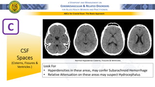 A VIEWPOINT AND MANAGEMENT ON
CEREBROVASCULAR & RELATED DISORDERS
FOR ALLIED HEALTH WORKERS AND PRACTITIONERS
ABCs for Cranial Scan: The Basic Approach
C
CSF
Spaces
(Cisterns, Fissures &
Ventricles ) Look For
• Hyperdensities in these areas, may confer Subarachnoid Hemorrhage
• Relative Attenuation on these areas may suspect Hydrocephalus
Normal Hypodense Cisterns, Fissures & Ventricles
 