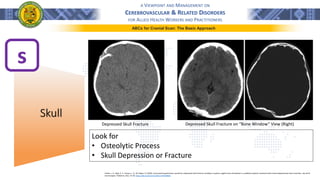 A VIEWPOINT AND MANAGEMENT ON
CEREBROVASCULAR & RELATED DISORDERS
FOR ALLIED HEALTH WORKERS AND PRACTITIONERS
ABCs for Cranial Scan: The Basic Approach
s
Skull
Forbes, J. A., Reig, A. S., Tomycz, L. D., & Tulipan, N. (2010). Intracranial hypertension caused by a depressed skull fracture resulting in superior sagittal sinus thrombosis in a pediatric patient: treatment with ventriculoperitoneal shunt insertion. Journal of
neurosurgery. Pediatrics, 6(1), 23–28. https://doi.org/10.3171/2010.3.PEDS09441
Depressed Skull Fracture Depressed Skull Fracture on “Bone Window” View (Right)
Look for
• Osteolytic Process
• Skull Depression or Fracture
 