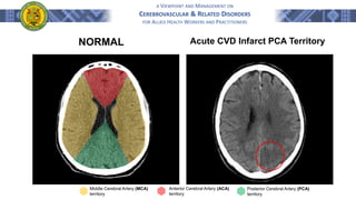 A VIEWPOINT AND MANAGEMENT ON
CEREBROVASCULAR & RELATED DISORDERS
FOR ALLIED HEALTH WORKERS AND PRACTITIONERS
NORMAL Acute CVD Infarct PCA Territory
Middle Cerebral Artery (MCA)
territory
Anterior Cerebral Artery (ACA)
territory
Posterior Cerebral Artery (PCA)
territory
 