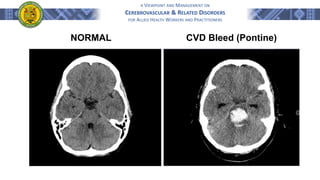 A VIEWPOINT AND MANAGEMENT ON
CEREBROVASCULAR & RELATED DISORDERS
FOR ALLIED HEALTH WORKERS AND PRACTITIONERS
NORMAL CVD Bleed (Pontine)
 