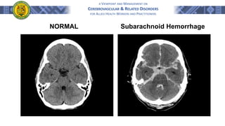 A VIEWPOINT AND MANAGEMENT ON
CEREBROVASCULAR & RELATED DISORDERS
FOR ALLIED HEALTH WORKERS AND PRACTITIONERS
NORMAL Subarachnoid Hemorrhage
 