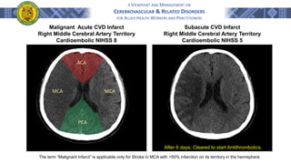 A VIEWPOINT AND MANAGEMENT ON
CEREBROVASCULAR & RELATED DISORDERS
FOR ALLIED HEALTH WORKERS AND PRACTITIONERS
Malignant Acute CVD Infarct
Right Middle Cerebral Artery Territory
Cardioembolic NIHSS 8
Subacute CVD Infarct
Right Middle Cerebral Artery Territory
Cardioembolic NIHSS 5
After 6 days; Cleared to start Antithrombotics
The term “Malignant Infarct” is applicable only for Stroke in MCA with >50% infarction on its territory in the hemisphere
ACA
PCA
MCA MCA
 