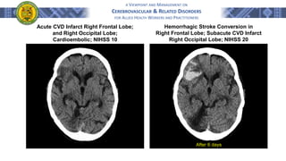 A VIEWPOINT AND MANAGEMENT ON
CEREBROVASCULAR & RELATED DISORDERS
FOR ALLIED HEALTH WORKERS AND PRACTITIONERS
Acute CVD Infarct Right Frontal Lobe;
and Right Occipital Lobe;
Cardioembolic; NIHSS 10
Hemorrhagic Stroke Conversion in
Right Frontal Lobe; Subacute CVD Infarct
Right Occipital Lobe; NIHSS 20
After 6 days
 