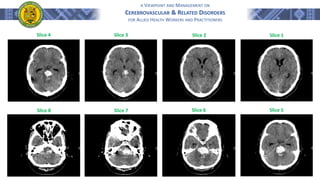 A VIEWPOINT AND MANAGEMENT ON
CEREBROVASCULAR & RELATED DISORDERS
FOR ALLIED HEALTH WORKERS AND PRACTITIONERS
Slice 1
Slice 5
Slice 6
Slice 7
Slice 8
Slice 2
Slice 3
Slice 4
 