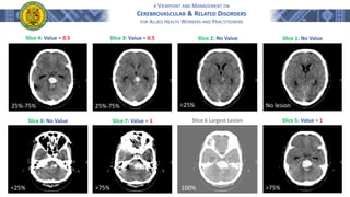 A VIEWPOINT AND MANAGEMENT ON
CEREBROVASCULAR & RELATED DISORDERS
FOR ALLIED HEALTH WORKERS AND PRACTITIONERS
Slice 1: No Value
Slice 5: Value = 1
Slice 6 Largest Lesion
Slice 7: Value = 1
Slice 8: No Value
Slice 2: No Value
Slice 3: Value = 0.5
Slice 4: Value = 0.5
100%
<25%
25%-75%
25%-75% No lesion
<25% >75% >75%
 