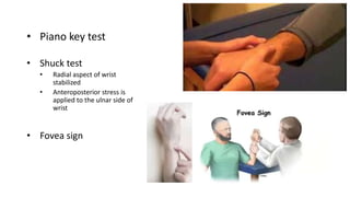 • Piano key test
• Shuck test
• Radial aspect of wrist
stabilized
• Anteroposterior stress is
applied to the ulnar side of
wrist
• Fovea sign
 