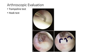 Arthroscopic Evaluation
• Trampoline test
• Hook test
 