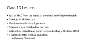 Class 1D Lesions
• Tear of TFCC from the radius at the distal end of sigmoid notch
• Oriented in AP direction
• May involve radioulnar ligaments
• Frequently a/w distal radius fractures
• Satisfactory reduction of radial fracture-healing with stable DRUJ
• If instability after fracture reduction
• Arthrocopic /Open repair
 