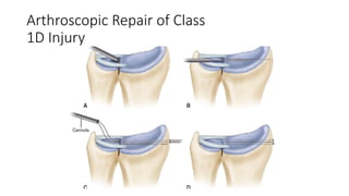 Arthroscopic Repair of Class
1D Injury
 