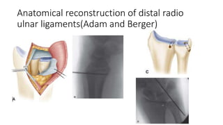 Anatomical reconstruction of distal radio
ulnar ligaments(Adam and Berger)
 