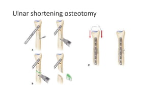 Ulnar shortening osteotomy
 