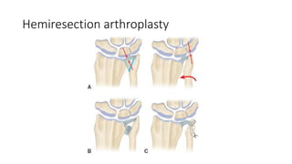 Hemiresection arthroplasty
 