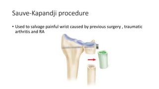 Sauve-Kapandji procedure
• Used to salvage painful wrist caused by previous surgery , traumatic
arthritis and RA
 