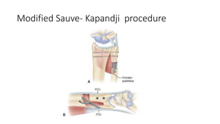 Modified Sauve- Kapandji procedure
 
