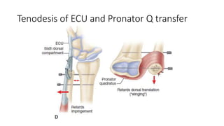 Tenodesis of ECU and Pronator Q transfer
 