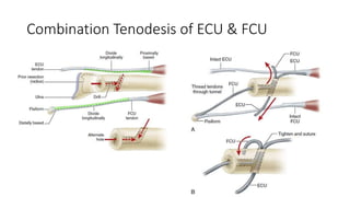 Combination Tenodesis of ECU & FCU
 