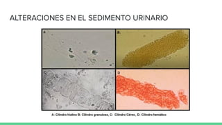 ALTERACIONES EN EL SEDIMENTO URINARIO
 